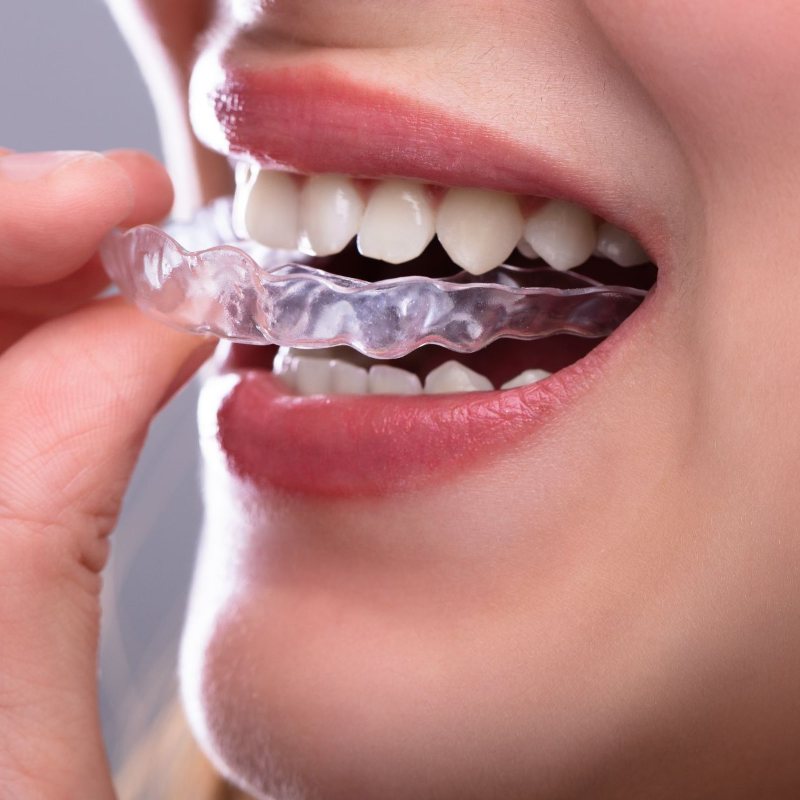 mujer con férula dental