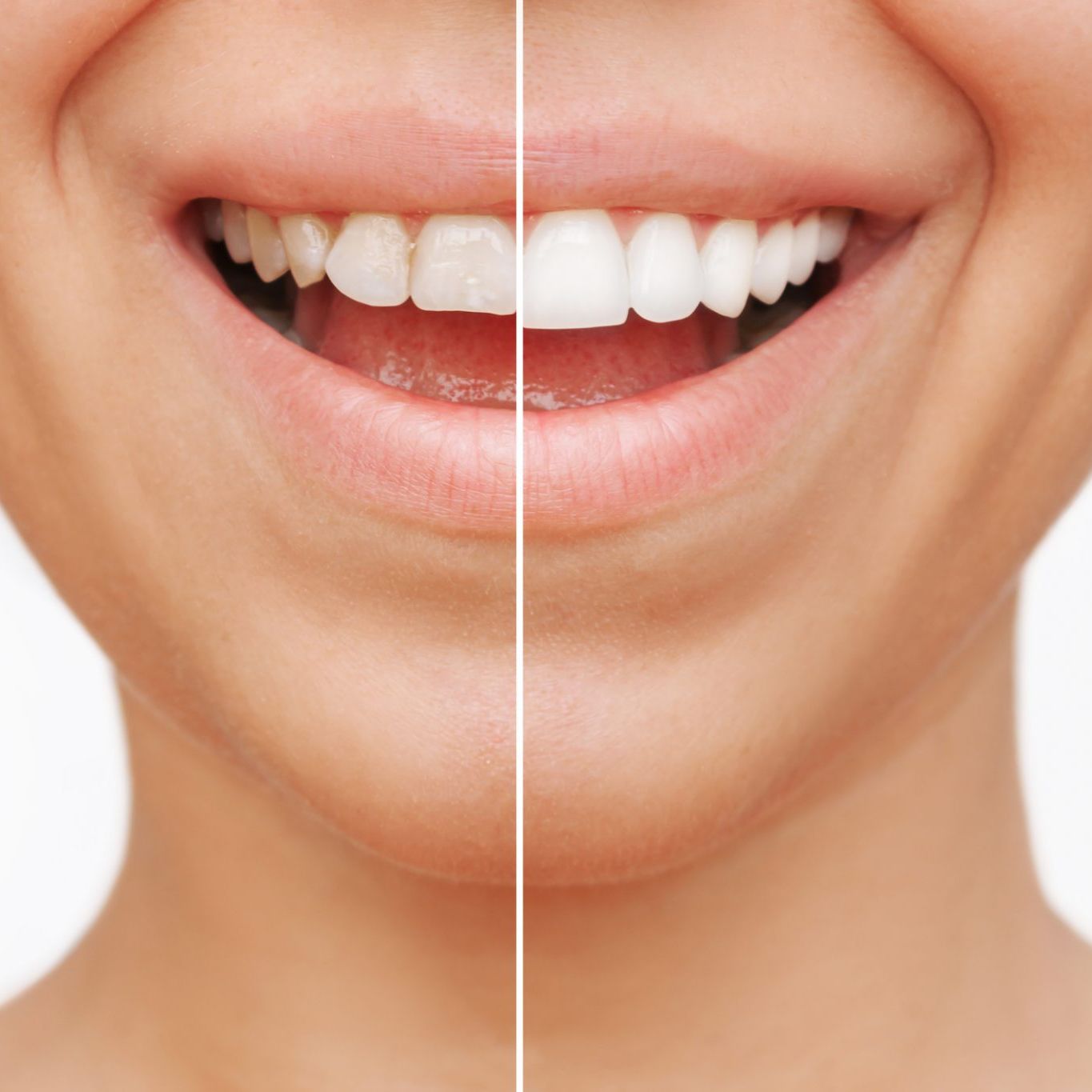 mujer con férula dental