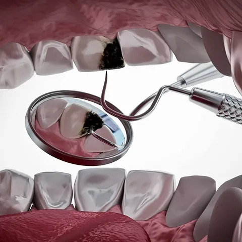 dentadura con caries